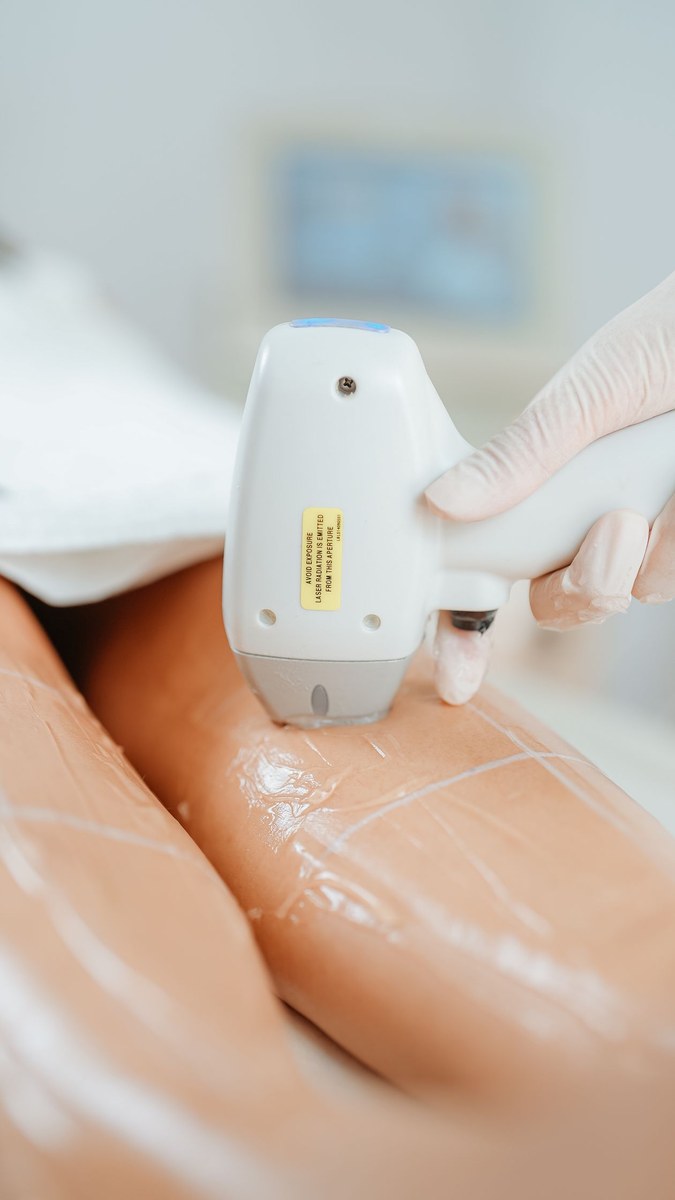 Gloved hand pressing a white laser hair-removal handpiece onto a gel-coated leg marked with grid lines